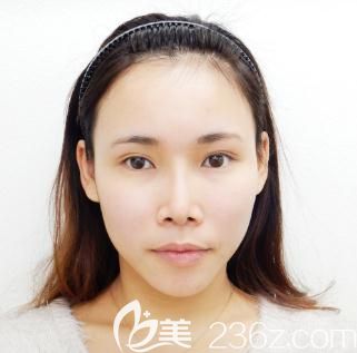 日本十仁做假體隆鼻加耳軟骨墊鼻尖術(shù)后一個(gè)月 日本十仁做假體隆鼻加耳軟骨墊鼻尖術(shù)后一個(gè)月