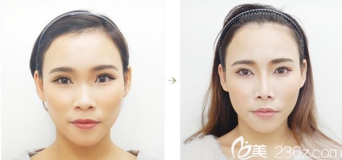 日本十仁做假體隆鼻加耳軟骨墊鼻尖手術(shù)前后對(duì)比 日本十仁做假體隆鼻加耳軟骨墊鼻尖手術(shù)前后對(duì)比