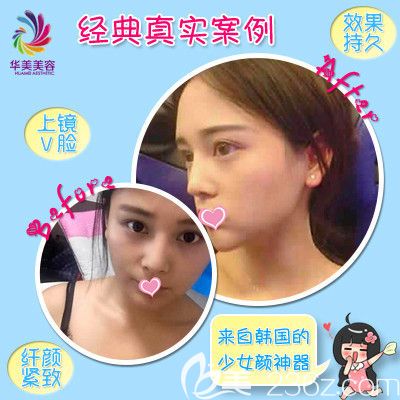 邯鄲華美注射除皺案例