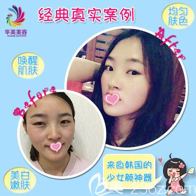 華美整形醫(yī)院激光祛斑案例