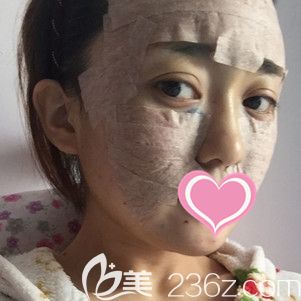 劉育鳳主任做自體脂肪面部填充術(shù)后即刻