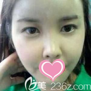 做自體脂肪全面部填充術(shù)后10天面部淤青腫脹消除