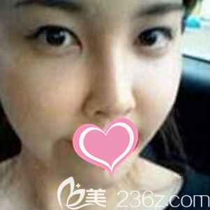 在上饒尚美整形做自體脂肪面部填充術(shù)后20天脂肪基本存活