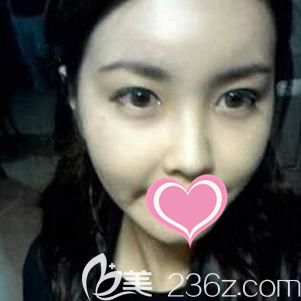 ?到上饒尚美醫(yī)療美容門診部做自體脂肪全面部填充后，才知道脂肪也是可以變“肥”為寶的