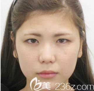 十仁美容找鳴海榮治做切開雙眼皮前 十仁美容找鳴海榮治做切開雙眼皮前