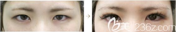 十仁美容找鳴海榮治做切開雙眼皮前后對比 十仁美容找鳴海榮治做切開雙眼皮前后對比