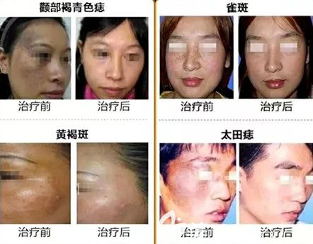 魏國祥醫(yī)生做激光祛斑案例 魏國祥醫(yī)生做激光祛斑案例