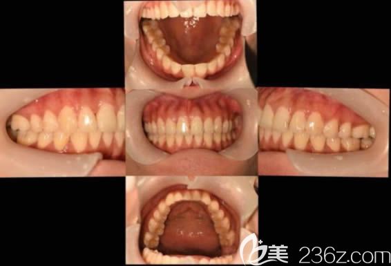 佩戴隱形牙套兩年多后的效果 佩戴隱形牙套兩年多后的效果