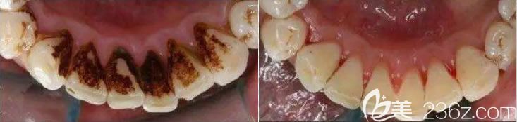 天津美奧口腔陳東來院長洗牙前后對比效果：