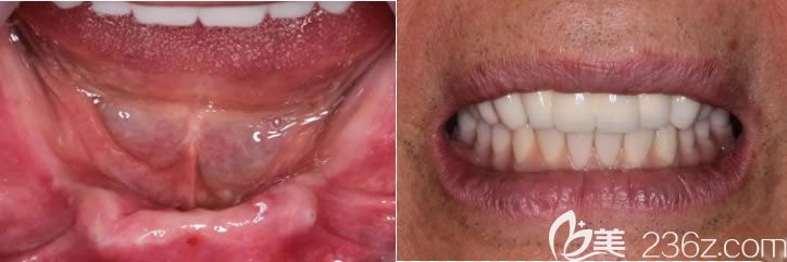 天津美奧口腔譚川云半口種植牙案例對(duì)比圖