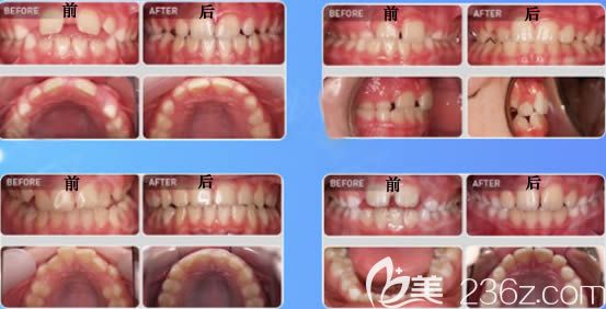 天津美奧口腔王醫(yī)生MRC肌功能矯正案例圖