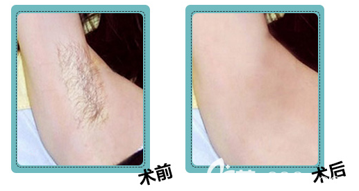 北京米蘭柏羽麗都脫毛案例