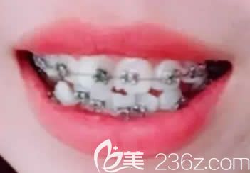 女兒在深圳格倫菲爾口腔剛開始做牙齒矯正 女兒在深圳格倫菲爾口腔剛開始做牙齒矯正