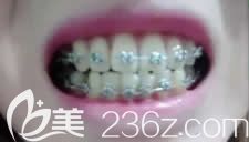 10歲的女兒在格倫菲爾口腔做牙齒矯正第3個月 10歲的女兒在格倫菲爾口腔做牙齒矯正第3個月