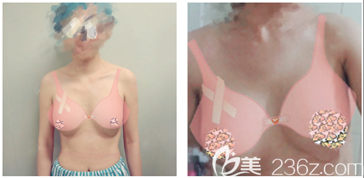 廣州荔灣區(qū)人民醫(yī)院整形美容中心齊云香術(shù)前照片1