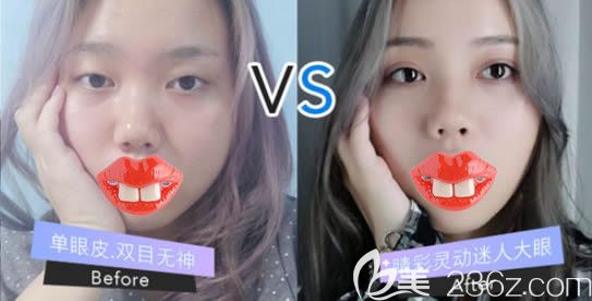 廈門陳運(yùn)生全切雙眼皮7mm一年后對比照片 廈門陳運(yùn)生全切雙眼皮7mm一年后對比照片