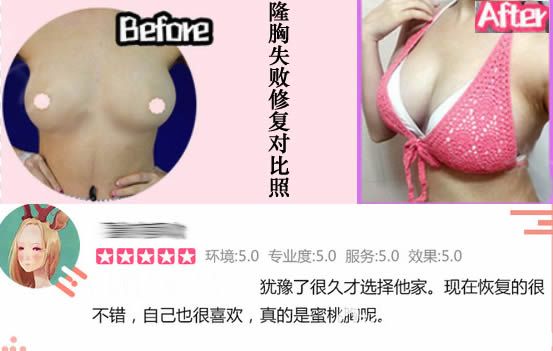 廈門華美賈虹醫(yī)生假體隆胸失敗修復(fù)案例圖 廈門華美賈虹醫(yī)生假體隆胸失敗修復(fù)案例圖
