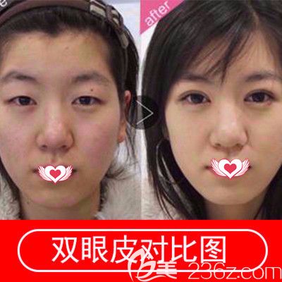 張家口維多利亞雙眼皮案例 張家口維多利亞雙眼皮案例