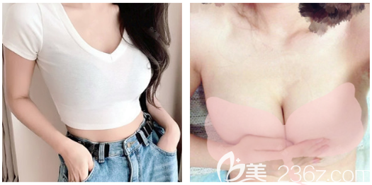 廣州荔灣區(qū)人民醫(yī)院整形美容中心齊云香術(shù)后照片1