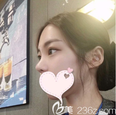 廣州紫馨李政祐隆鼻術(shù)后照片 廣州紫馨李政祐隆鼻術(shù)后照片