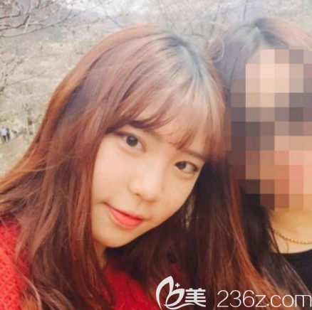 在廣州紫馨隆鼻術(shù)前照片 在廣州紫馨隆鼻術(shù)前照片