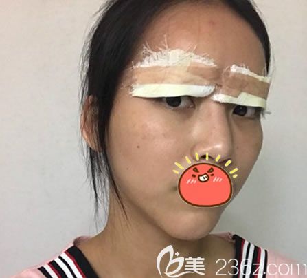 瑞安瑞麗做雙眼皮即刻效果