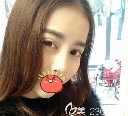 瑞安瑞麗做全切雙眼皮7天效果