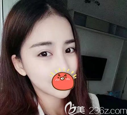 溫州瑞安瑞麗整形雙眼皮案例