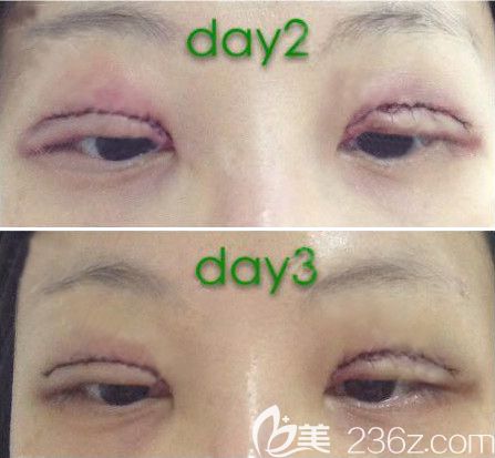 西寧時(shí)光雙眼皮術(shù)后前3天 西寧時(shí)光雙眼皮術(shù)后前3天