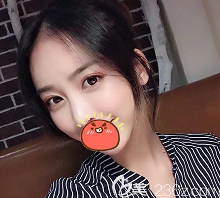 我來給大家寫一下在溫州瑞安瑞麗整形美容醫(yī)院做全切雙眼皮全過程及術后感受