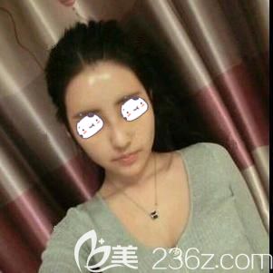 做自體脂肪面部填充術(shù)后10天臉部腫脹消除針孔消失 做自體脂肪面部填充術(shù)后10天臉部腫脹消除針孔消失