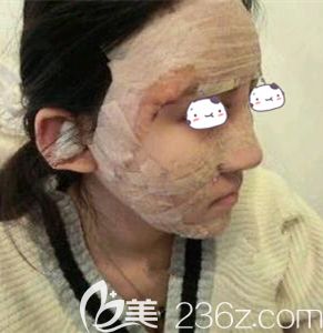 謝靚花主任幫我做自體脂肪面部填充術(shù)后即刻 謝靚花主任幫我做自體脂肪面部填充術(shù)后即刻