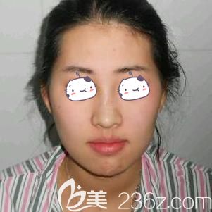 到贛州韓美整形美容醫(yī)院面診前面部凹陷的自己 到贛州韓美整形美容醫(yī)院面診前面部凹陷的自己