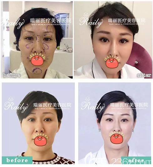 溫州瑞安瑞麗王俞明脂肪填充案例 溫州瑞安瑞麗王俞明脂肪填充案例