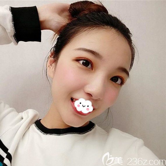 武漢藝星美杜莎雙眼皮真人案例