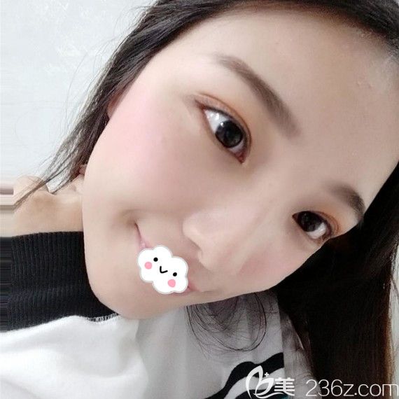 武漢雙眼皮醫(yī)生哪個好？武漢藝星<!--<i data=20240703-sp></i>-->案例