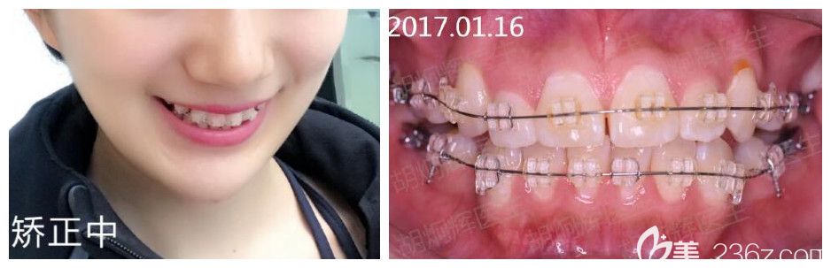 找胡炯輝做虎牙矯正快4個(gè)月效果 找胡炯輝做虎牙矯正快4個(gè)月效果