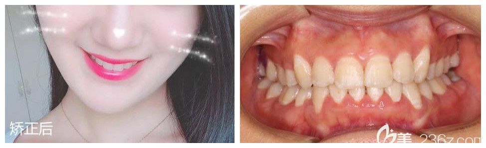 曬下我在重慶牙博士口腔做虎牙矯正戴牙套變化圖 2年牙套畢業(yè)啦