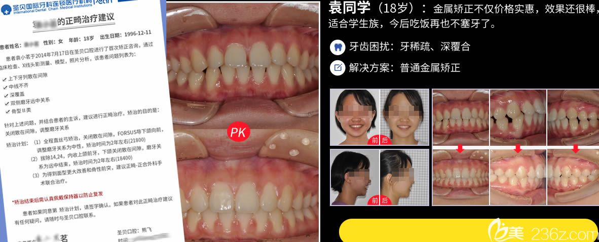 廣州圣貝口腔熊飛牙齒正畸案例圖 廣州圣貝口腔熊飛牙齒正畸案例圖
