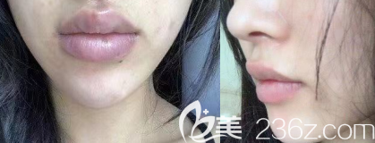 國(guó)內(nèi)厚唇改薄案例