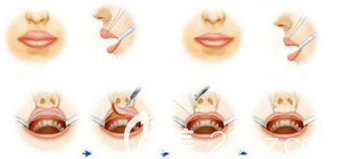 厚唇改薄手術(shù)過程