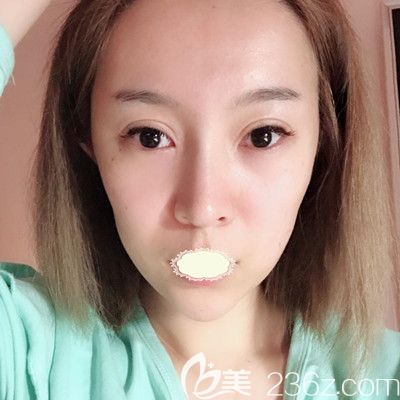 哈爾濱臻美<!--<i data=20240703-sp></i>-->面部自體脂肪填充術(shù)前照 哈爾濱臻美<!--<i data=20240703-sp></i>-->面部自體脂肪填充術(shù)前照