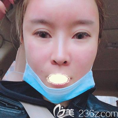 哈爾濱臻美<!--<i data=20240703-sp></i>-->面部自體脂肪填充術(shù)后1天效果展示 哈爾濱臻美<!--<i data=20240703-sp></i>-->面部自體脂肪填充術(shù)后1天效果展示