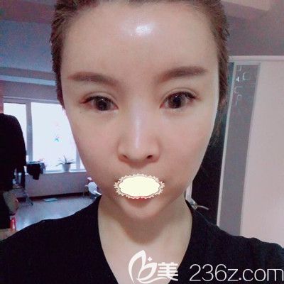 哈爾濱臻美<!--<i data=20240703-sp></i>-->面部自體脂肪填充術(shù)后7天對(duì)比圖 哈爾濱臻美<!--<i data=20240703-sp></i>-->面部自體脂肪填充術(shù)后7天對(duì)比圖