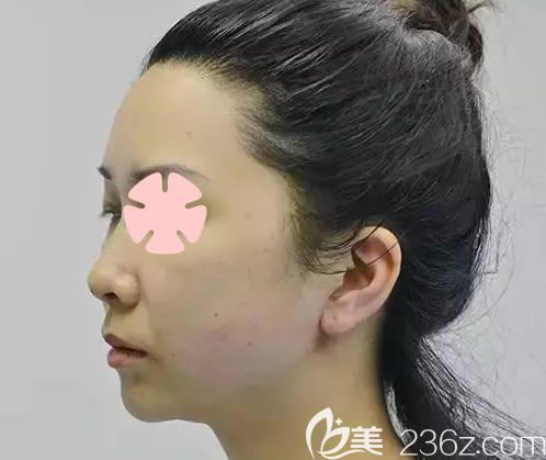 我在南寧美麗焦點(diǎn)整形做全臉埋線提升后