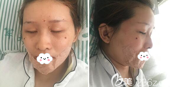 王家勇面部脂肪填充術(shù)后即刻 王家勇面部脂肪填充術(shù)后即刻