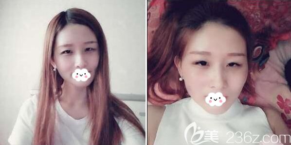 <i data-id='17203d02-faea-440e-a3d8-4cc46ae0fcf7' style='display:none;'></i>王家勇面部脂肪填充術(shù)后一個月 <i data-id='17203d02-faea-440e-a3d8-4cc46ae0fcf7' style='display:none;'></i>王家勇面部脂肪填充術(shù)后一個月