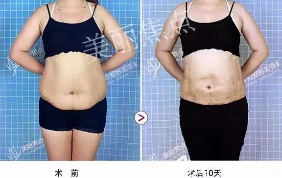 我在南寧美麗焦點(diǎn)做腰腹吸脂前后對比照片 我在南寧美麗焦點(diǎn)做腰腹吸脂前后對比照片
