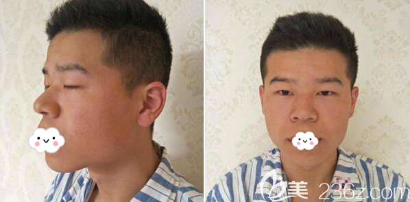 單眼皮和面部的凹陷一直是我的困擾 單眼皮和面部的凹陷一直是我的困擾