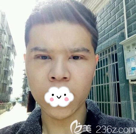 <i data-id='6f25ea73-45be-43f6-8020-50cbfcde0b3a' style='display:none;'></i>文科埋線雙眼皮術(shù)后4天 <i data-id='6f25ea73-45be-43f6-8020-50cbfcde0b3a' style='display:none;'></i>文科埋線雙眼皮術(shù)后4天